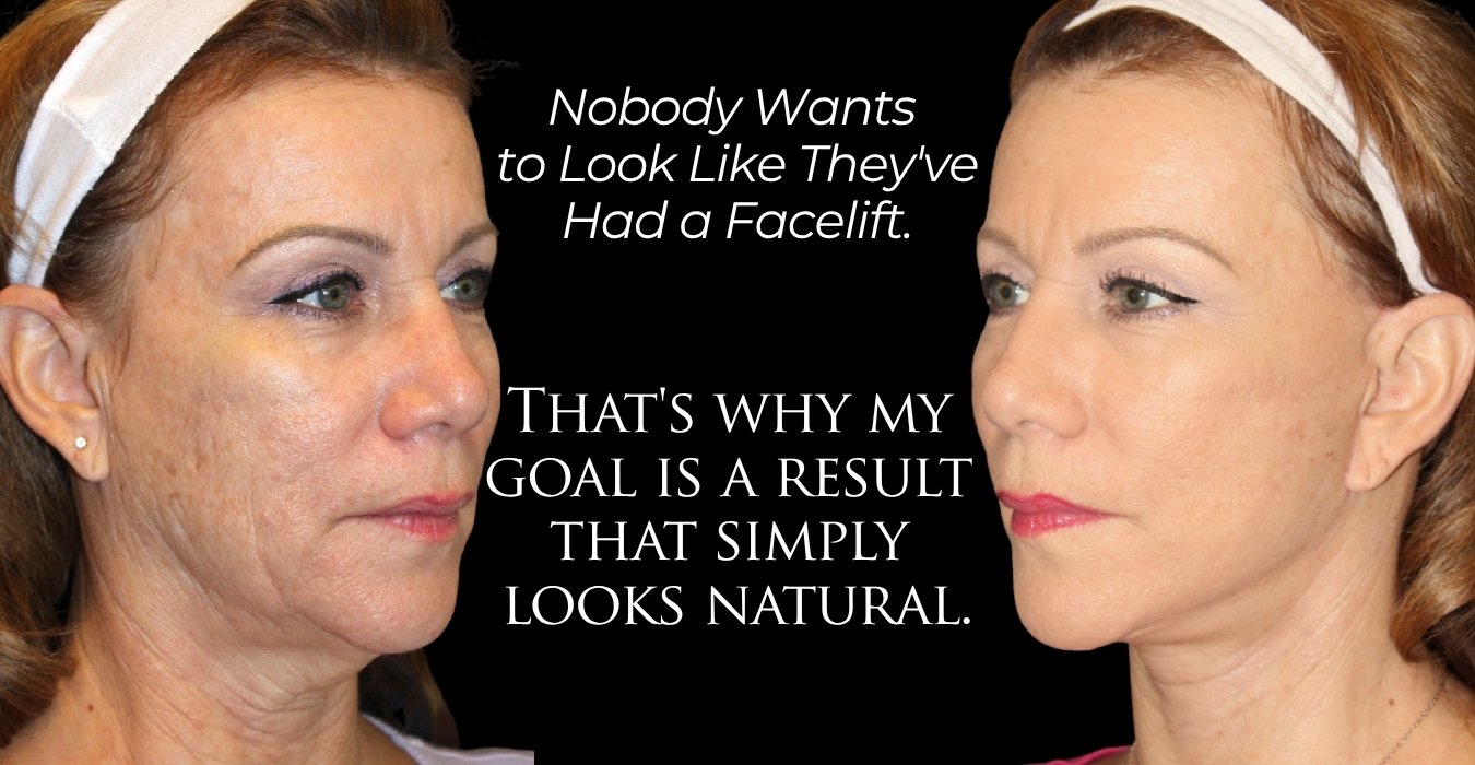 Before and after facelift surgery with Dr. Champagne.